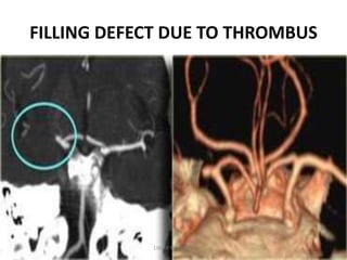 FILLING DEFECT DUE TO THROMBUS
DR.SVM MDRD
 