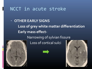 NCCT in acute stroke
▪ OTHER EARLY SIGNS
Loss of grey white matter differentiation
Early mass effect-
Narrowing of sylvian fissure
Loss of cortical sulci
 