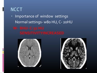 NCCT
▪ Importance of window settings
Normal settings- w80 HU,C- 20HU
W- 8HU- C-32 HU
SENSITIVITYINCREASED
 