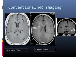 Conventional MR imaging
Hyperacute infarct Subacute infarct
 