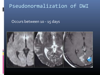 Pseudonormalization of DWI
Occurs between 10 - 15 days
 