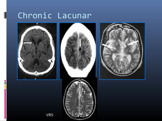 Chronic Lacunar
infarcts
VRS
 