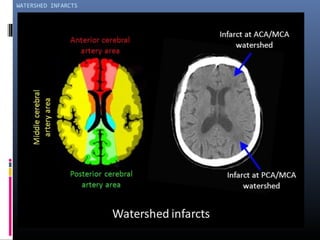 WATERSHED INFARCTS
 