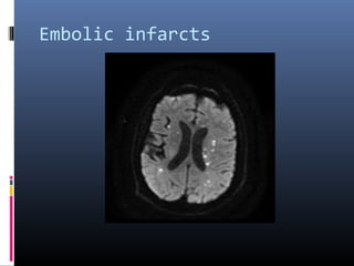 Embolic infarcts
 