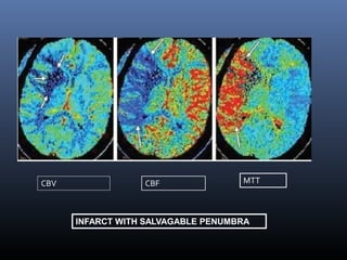 CBV CBF MTT
INFARCT WITH SALVAGABLE PENUMBRA
 