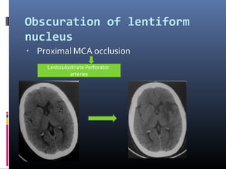Obscuration of lentiform
nucleus
▪ Proximal MCA occlusion
Lenticulostriate Perforator
arteries
 