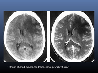 Round shaped hypodense lesion .more probably tumor.
 