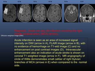 Diffusion weighted image (DWI)
9.1a 9.1b 9.1c 9.1d 9.1e 9.1f
Diagnosis: Acute one day old infarction involving the right
middle cerebral artery (MCA) territory.
Acute infarction is seen as an area of increased signal
intensity on DWI (arrow in A), FLAIR image (arrow in B), with
no evidence of hemorrhage on T1-wtd image (C) and no
enhancement on post contrast images (D). Intravascular
enhancement also an indication of acute stroke is shown on
coronal T1 weighted image (arrow in F). MR angiography of
circle of Willis demonstrates small caliber of right Sylvian
branches of MCA (arrows in E) when compared to the normal
side.
 