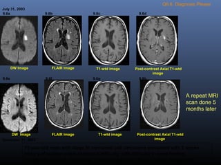 Q9.6. Diagnosis Please
July 31, 2003
T1-wtd imageDW Image FLAIR Image Post-contrast Axial T1-wtd
image
9.6a 9.6b 9.6c 9.6d
December 31, 2003
DW Image FLAIR Image T1-wtd image Post-contrast Axial T1-wtd
image
9.6e 9.6f 9.6g 9.6h
73 year-old male with stage IV non-small cell carcinoma presented with 2 weeks
history of sudden onset of speech difficulty with difficulty in word finding,
symptoms gradually improved. Clinical diagnosis: Stroke versus metastasis.
A repeat MRI
scan done 5
months later
 