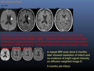Q9.6. Diagnosis Please
July 31, 2003
December 31, 2003
Diagnosis: Non-hemorrhagic subacute enhancing infarct (2 weeks old)
involving the left basal ganglia region. Subacute infarct is seen as an area
of increased signal intensity on FLAIR image (arrow in B) and bright signal
intensity on DWI (arrow in A). Enhancement of the infarct is shown on post
contrast image (arrow in D).
A repeat MRI scan done 5 months
later showed resolution of infarct and
no evidence of bright signal intensity
on diffusion weighted image E.
5 months old infarct.
9.6a 9.6b 9.6c 9.6d
9.6e 9.6f 9.6g 9.6h
 