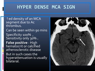 HYPER DENSE MCA SIGN
 ↑ed density of an MCA
segment due to Ac
thrombus.
 Can be seen within 90 mins
 Specificity 100% ,
Sensitivity only 30% .
 False positive : High
hematocrit or calcified
atherosclerotic disease
 But in such cases the
hyperattenuation is usually
bilateral.
 