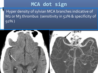 MCA dot sign
 Hyper density of sylvian MCA branches indicative of
M2 or M3 thrombus (sensitivity in 52% & specificity of
92% )
 