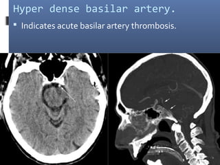 Hyper dense basilar artery.
 Indicates acute basilar artery thrombosis.
 