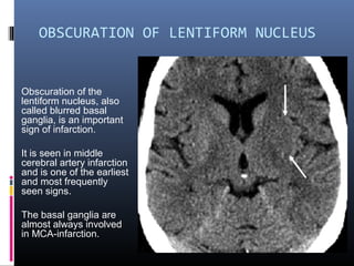 OBSCURATION OF LENTIFORM NUCLEUS
Obscuration of the
lentiform nucleus, also
called blurred basal
ganglia, is an important
sign of infarction.
It is seen in middle
cerebral artery infarction
and is one of the earliest
and most frequently
seen signs.
The basal ganglia are
almost always involved
in MCA-infarction.
 