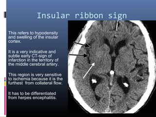 Insular ribbon sign
This refers to hypodensity
and swelling of the insular
cortex.
It is a very indicative and
subtle early CT-sign of
infarction in the territory of
the middle cerebral artery.
This region is very sensitive
to ischemia because it is the
furthest from collateral flow.
It has to be differentiated
from herpes encephalitis.
 