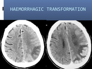 HAEMORRHAGIC TRANSFORMATION
 