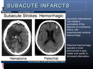 SUBACUTE INFARCTSSUBACUTE INFARCTS
Petechial haemorrhage
typically is more
pronounced in grey
matter and results in
increased attenuation.
secondary haematomas
are merely a
summation of the
features of a ischaemic
infarct, with
superimposed cerebral
haemorrhage
 
