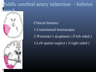 Middle cerebral artery infarction - Inferior
branch
Clinical features
1.Contralateral hemianopia.
2.Wernicke’s dysphasia ( if left sided )
3.Left spatial neglect ( if right sided )
 