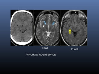 VIRCHOW ROBIN SPACE
FLAIR
T2WI
 