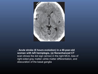 . Acute stroke (6 hours evolution) in a 46-year-old
woman with left hemiplegia. (a) Nonenhanced CT
scan shows the dot sign (arrow) in the right MCA, loss of
right-sided gray matter–white matter differentiation, and
obscuration of the basal ganglia
 