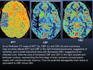 MTT
CBV
CBF
(b–e) Perfusion CT maps of MTT (b), CBF (c), and CBV (d) and a summary
map (e) show altered MTT and CBF in the right frontotemporal area, suggestive of
ischemia, and a small subcortical area with decreased CBV, suggestive of an
infarcted core. Note the area of increased CBF and CBV in the right caudate and
lenticular nucleus, representing the first stage of brain ischemia (compensatory
supply with cerebrovascular reserve). Thus the potential salvageable brain tissue is
equivalent to CBF minus CBV
 