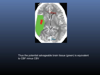 Thus the potential salvageable brain tissue (green) is equivalent
to CBF minus CBV
 