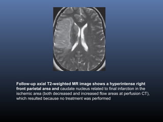 Follow-up axial T2-weighted MR image shows a hyperintense right
front parietal area and caudate nucleus related to final infarction in the
ischemic area (both decreased and increased flow areas at perfusion CT),
which resulted because no treatment was performed
 