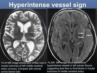 Hyperintense vessel sign
FLAIR MR image show punctiform
hyperintense vessels in left sylvian fissure
suggesting slow flow or thrombosis in insular
branches of middle cerebral artery
T2-W MR image shows lack of flow void in
insular branches of left middle cerebral
artery (arrows). Compare with normal
contra lateral side.
 