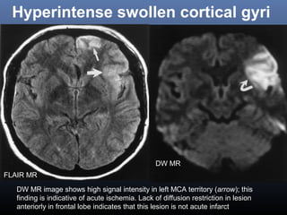 Hyperintense swollen cortical gyri
DW MR image shows high signal intensity in left MCA territory (arrow); this
finding is indicative of acute ischemia. Lack of diffusion restriction in lesion
anteriorly in frontal lobe indicates that this lesion is not acute infarct
FLAIR MR
DW MR
 