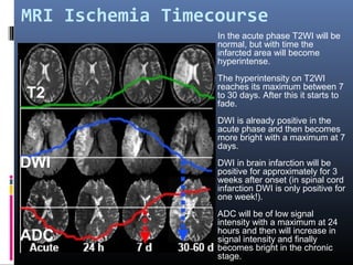 MRI Ischemia Timecourse
T2
DWI
ADC
In the acute phase T2WI will be
normal, but with time the
infarcted area will become
hyperintense.
The hyperintensity on T2WI
reaches its maximum between 7
to 30 days. After this it starts to
fade.
DWI is already positive in the
acute phase and then becomes
more bright with a maximum at 7
days.
DWI in brain infarction will be
positive for approximately for 3
weeks after onset (in spinal cord
infarction DWI is only positive for
one week!).
ADC will be of low signal
intensity with a maximum at 24
hours and then will increase in
signal intensity and finally
becomes bright in the chronic
stage.
 