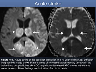 Acute stroke
Figure 15a. Acute stroke of the posterior circulation in a 77-year-old man. (a) Diffusion-
weighted MR image shows bilateral areas of increased signal intensity (arrows) in the
thalami and occipital lobes. (b) ADC map shows decreased ADC values in the same
areas (arrows). These findings are indicative of acute ischemia
 