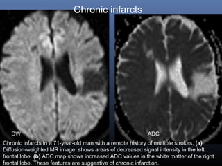 DW ADC
Chronic infarcts
Chronic infarcts in a 71-year-old man with a remote history of multiple strokes. (a)
Diffusion-weighted MR image shows areas of decreased signal intensity in the left
frontal lobe. (b) ADC map shows increased ADC values in the white matter of the right
frontal lobe. These features are suggestive of chronic infarction.
 