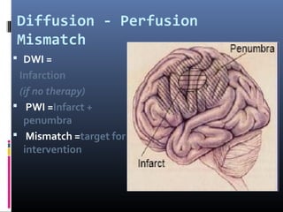 Diffusion - Perfusion
Mismatch
 DWI =
Infarction
(if no therapy)
 PWI =Infarct +
penumbra
 Mismatch =target for
intervention
 