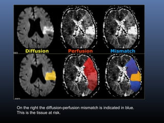 On the right the diffusion-perfusion mismatch is indicated in blue.
This is the tissue at risk.
 
