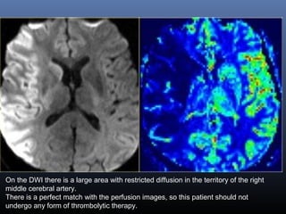 On the DWI there is a large area with restricted diffusion in the territory of the right
middle cerebral artery.
There is a perfect match with the perfusion images, so this patient should not
undergo any form of thrombolytic therapy.
 