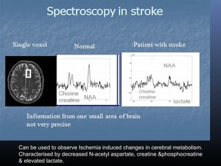 Can be used to observe Ischemia induced changes in cerebral metabolism.
Characterised by decreased N-acetyl aspartate, creatine &phosphocreatine
& elevated lactate.
 