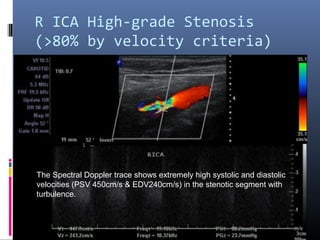 R ICA High-grade Stenosis
(>80% by velocity criteria)
The Spectral Doppler trace shows extremely high systolic and diastolic
velocities (PSV 450cm/s & EDV240cm/s) in the stenotic segment with
turbulence.
 