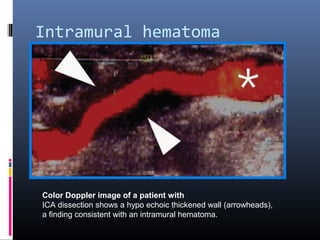 Intramural hematoma
Color Doppler image of a patient with
ICA dissection shows a hypo echoic thickened wall (arrowheads),
a finding consistent with an intramural hematoma.
 