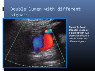 Double lumen with different
signals
Figure 7. Color
Doppler image of
a patient with ICA
dissection shows a
double lumen with
different signals
 