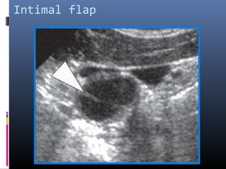 Intimal flap
 