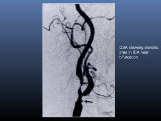 DSA showing stenotic
area in ICA near
bifurcation
 