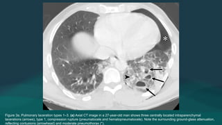 Pulmonary Rupture Imaging Manifestations and Radiologic Approach to Chest Trauma ...