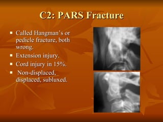 Non Displaced Pars Defect Imaging In Trauma | PPT