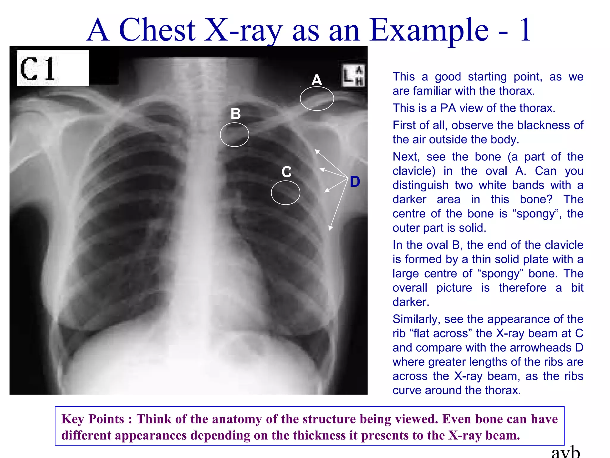 A Chest X-ray as an Example - 1
This a good starting point, as we
are familiar with the thorax.
This is a PA view of the thorax.
First of all, observe the blackness of
the air outside the body.
Next, see the bone (a part of the
clavicle) in the oval A. Can you
distinguish two white bands with a
darker area in this bone? The
centre of the bone is “spongy”, the
outer part is solid.
In the oval B, the end of the clavicle
is formed by a thin solid plate with a
large centre of “spongy” bone. The
overall picture is therefore a bit
darker.
Similarly, see the appearance of the
rib “flat across” the X-ray beam at C
and compare with the arrowheads D
where greater lengths of the ribs are
across the X-ray beam, as the ribs
curve around the thorax.
A
B
C
D
Key Points : Think of the anatomy of the structure being viewed. Even bone can have
different appearances depending on the thickness it presents to the X-ray beam.
 