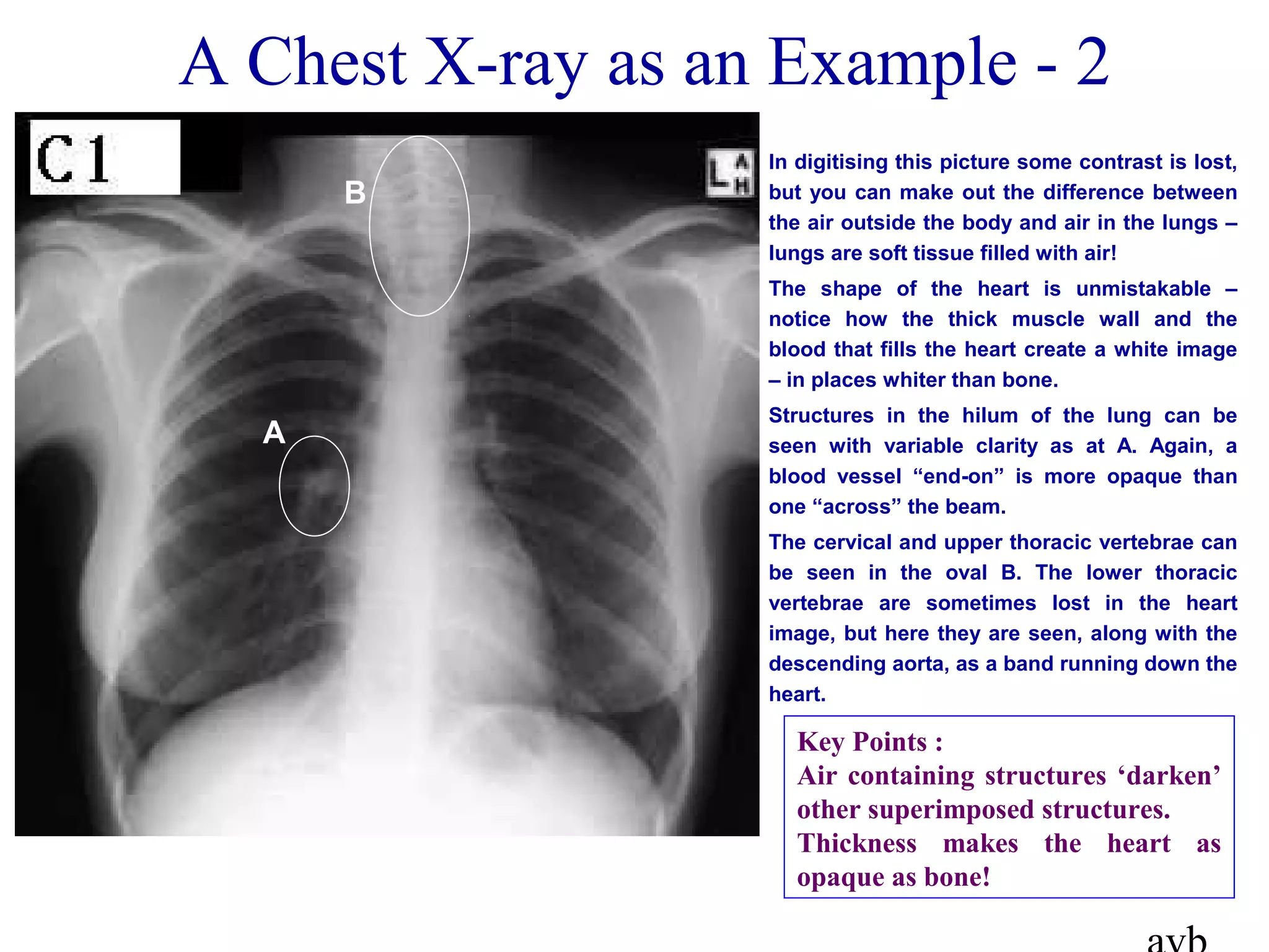 A Chest X-ray as an Example - 2
In digitising this picture some contrast is lost,
but you can make out the difference between
the air outside the body and air in the lungs –
lungs are soft tissue filled with air!
The shape of the heart is unmistakable –
notice how the thick muscle wall and the
blood that fills the heart create a white image
– in places whiter than bone.
Structures in the hilum of the lung can be
seen with variable clarity as at A. Again, a
blood vessel “end-on” is more opaque than
one “across” the beam.
The cervical and upper thoracic vertebrae can
be seen in the oval B. The lower thoracic
vertebrae are sometimes lost in the heart
image, but here they are seen, along with the
descending aorta, as a band running down the
heart.
A
B
Key Points :
Air containing structures ‘darken’
other superimposed structures.
Thickness makes the heart as
opaque as bone!
 