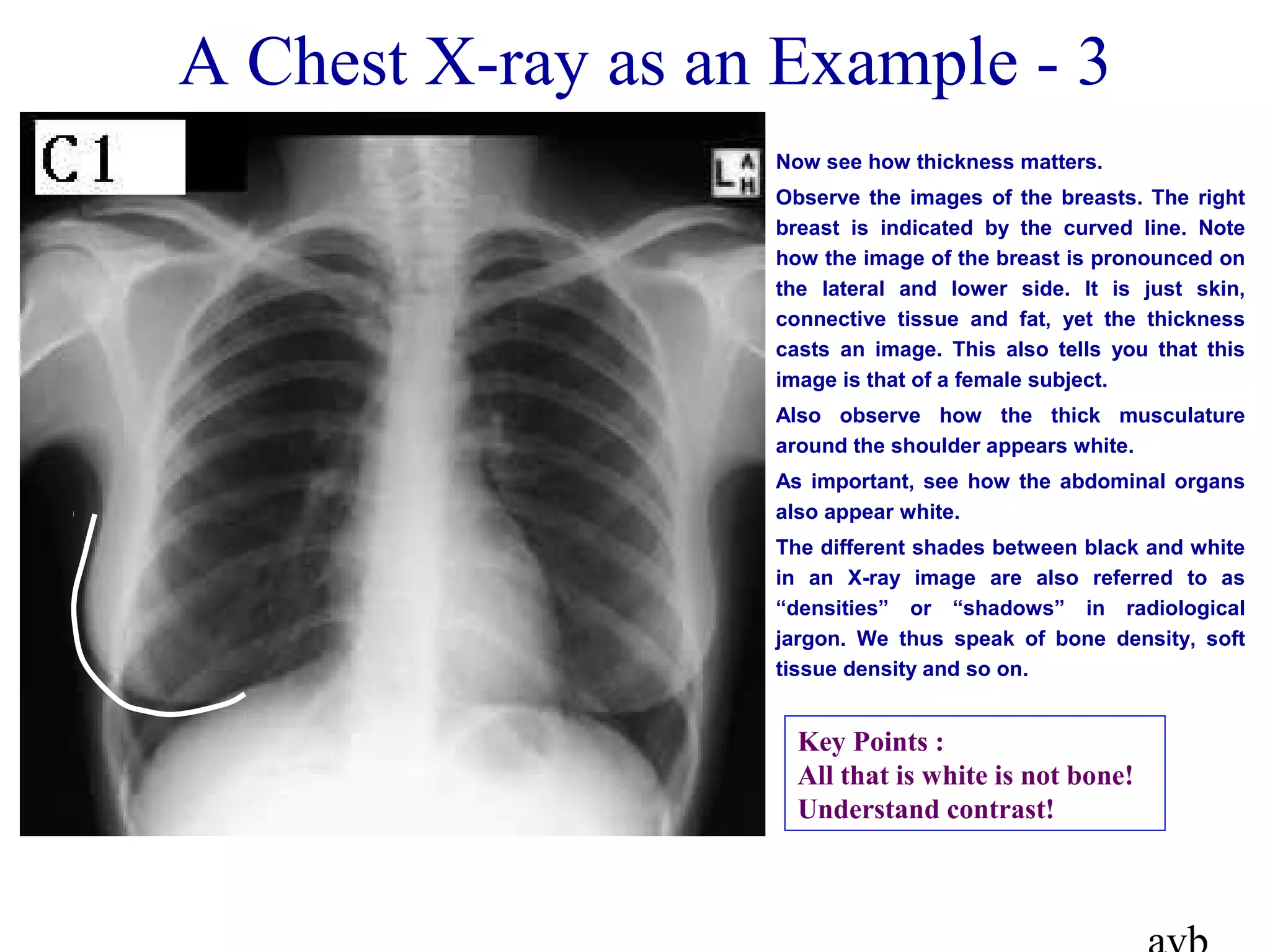 A Chest X-ray as an Example - 3
Now see how thickness matters.
Observe the images of the breasts. The right
breast is indicated by the curved line. Note
how the image of the breast is pronounced on
the lateral and lower side. It is just skin,
connective tissue and fat, yet the thickness
casts an image. This also tells you that this
image is that of a female subject.
Also observe how the thick musculature
around the shoulder appears white.
As important, see how the abdominal organs
also appear white.
The different shades between black and white
in an X-ray image are also referred to as
“densities” or “shadows” in radiological
jargon. We thus speak of bone density, soft
tissue density and so on.
Key Points :
All that is white is not bone!
Understand contrast!
 