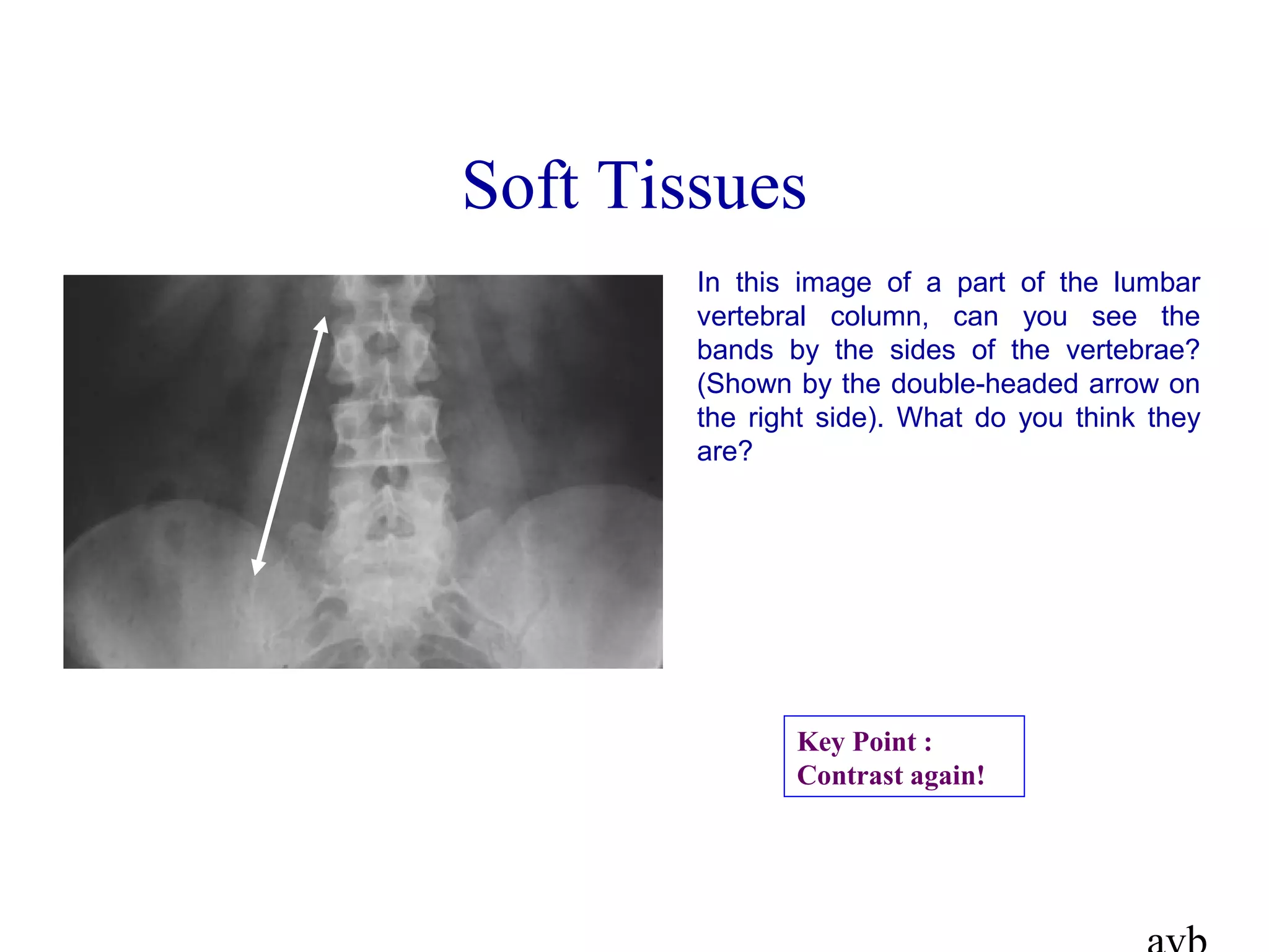 In this image of a part of the lumbar
vertebral column, can you see the
bands by the sides of the vertebrae?
(Shown by the double-headed arrow on
the right side). What do you think they
are?
Soft Tissues
Key Point :
Contrast again!
 