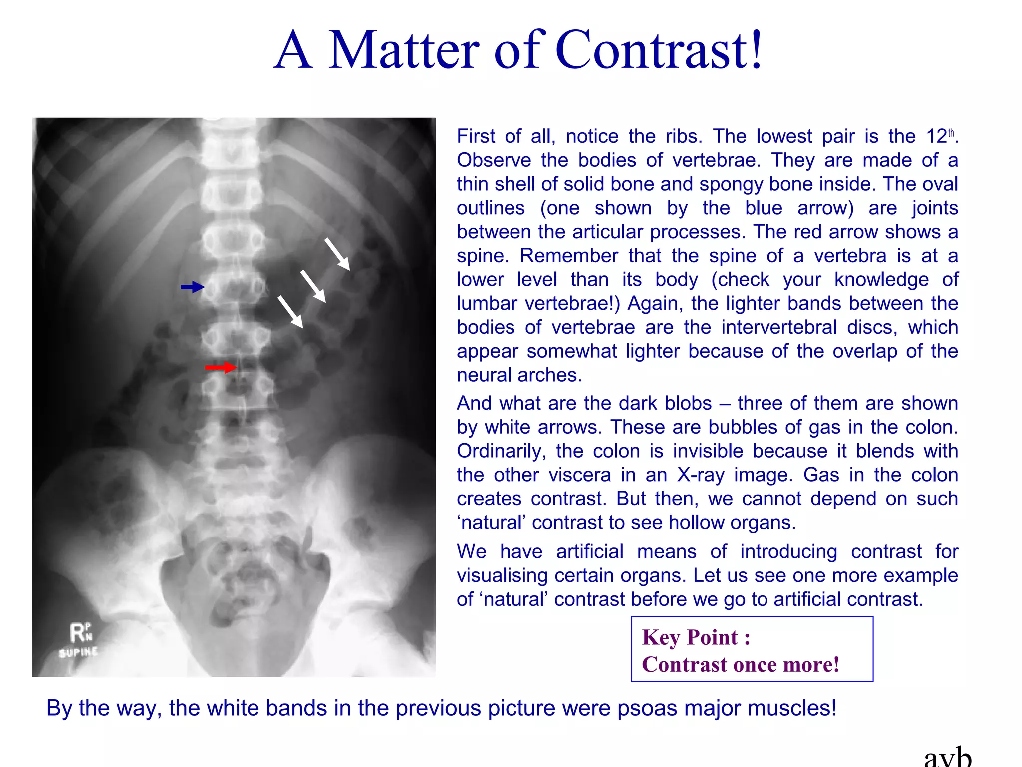 A Matter of Contrast!
First of all, notice the ribs. The lowest pair is the 12th
.
Observe the bodies of vertebrae. They are made of a
thin shell of solid bone and spongy bone inside. The oval
outlines (one shown by the blue arrow) are joints
between the articular processes. The red arrow shows a
spine. Remember that the spine of a vertebra is at a
lower level than its body (check your knowledge of
lumbar vertebrae!) Again, the lighter bands between the
bodies of vertebrae are the intervertebral discs, which
appear somewhat lighter because of the overlap of the
neural arches.
And what are the dark blobs – three of them are shown
by white arrows. These are bubbles of gas in the colon.
Ordinarily, the colon is invisible because it blends with
the other viscera in an X-ray image. Gas in the colon
creates contrast. But then, we cannot depend on such
‘natural’ contrast to see hollow organs.
We have artificial means of introducing contrast for
visualising certain organs. Let us see one more example
of ‘natural’ contrast before we go to artificial contrast.
By the way, the white bands in the previous picture were psoas major muscles!
Key Point :
Contrast once more!
 