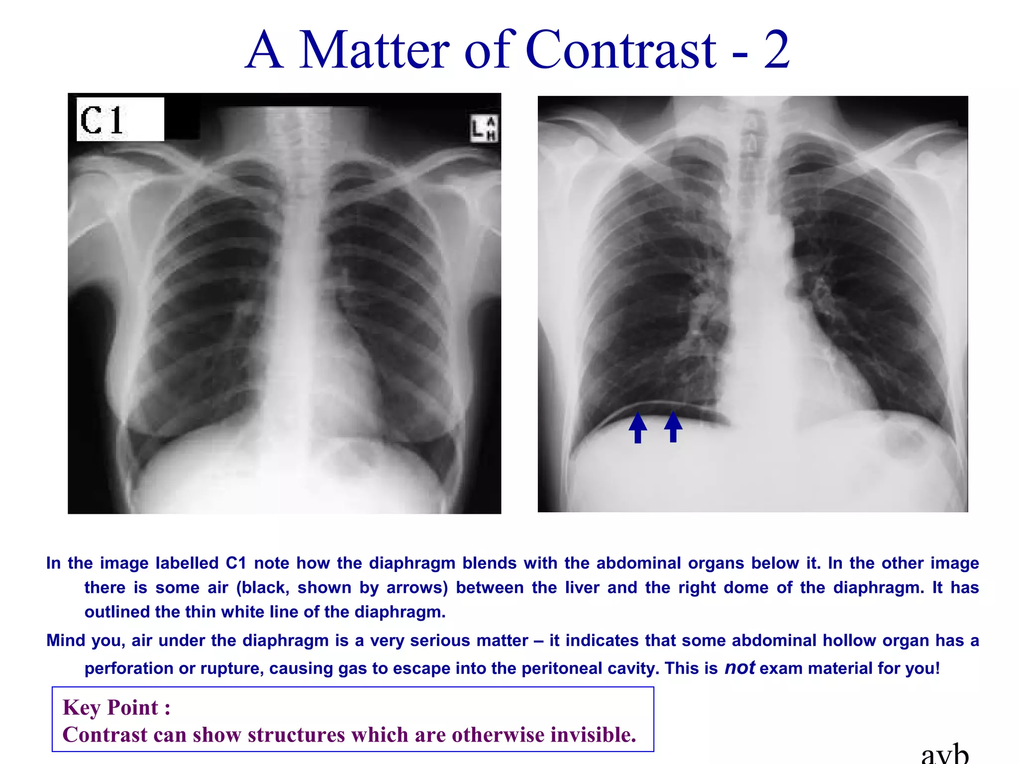 A Matter of Contrast - 2
In the image labelled C1 note how the diaphragm blends with the abdominal organs below it. In the other image
there is some air (black, shown by arrows) between the liver and the right dome of the diaphragm. It has
outlined the thin white line of the diaphragm.
Mind you, air under the diaphragm is a very serious matter – it indicates that some abdominal hollow organ has a
perforation or rupture, causing gas to escape into the peritoneal cavity. This is not exam material for you!
Key Point :
Contrast can show structures which are otherwise invisible.
 