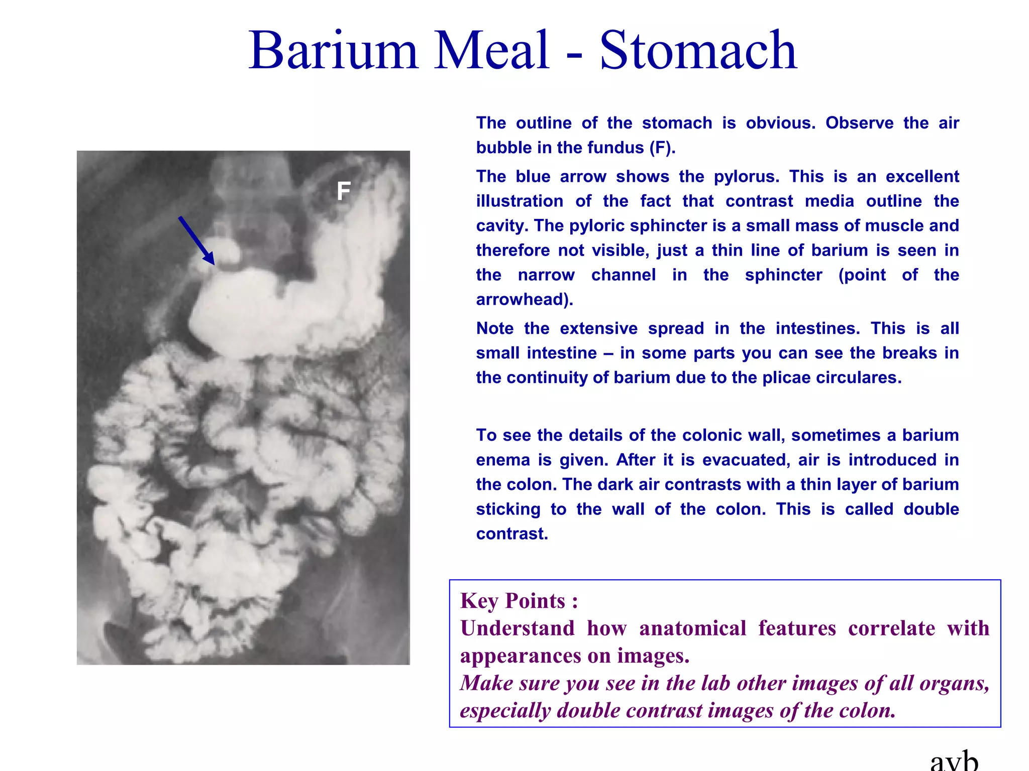 Barium Meal - Stomach
The outline of the stomach is obvious. Observe the air
bubble in the fundus (F).
The blue arrow shows the pylorus. This is an excellent
illustration of the fact that contrast media outline the
cavity. The pyloric sphincter is a small mass of muscle and
therefore not visible, just a thin line of barium is seen in
the narrow channel in the sphincter (point of the
arrowhead).
Note the extensive spread in the intestines. This is all
small intestine – in some parts you can see the breaks in
the continuity of barium due to the plicae circulares.
To see the details of the colonic wall, sometimes a barium
enema is given. After it is evacuated, air is introduced in
the colon. The dark air contrasts with a thin layer of barium
sticking to the wall of the colon. This is called double
contrast.
F
Key Points :
Understand how anatomical features correlate with
appearances on images.
Make sure you see in the lab other images of all organs,
especially double contrast images of the colon.
 